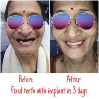 https://dentalimplantmumbai.in/wp-content/uploads/2021/10/COMPLETE-DENTAL-SOLUTIONS-3-320x320.png