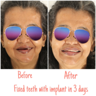 https://dentalimplantmumbai.in/wp-content/uploads/2021/10/COMPLETE-DENTAL-SOLUTIONS-4-320x320.png