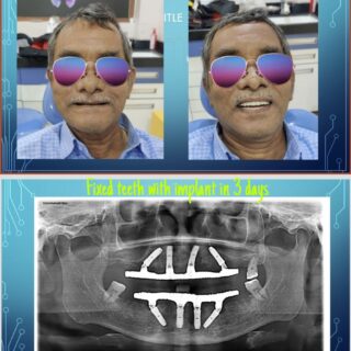 https://dentalimplantmumbai.in/wp-content/uploads/2021/10/preview-4-320x320.jpg