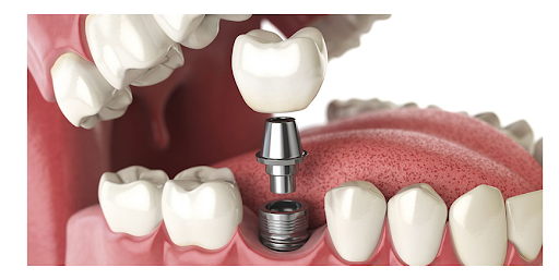 https://dentalimplantmumbai.in/wp-content/uploads/2021/10/unnamed.png