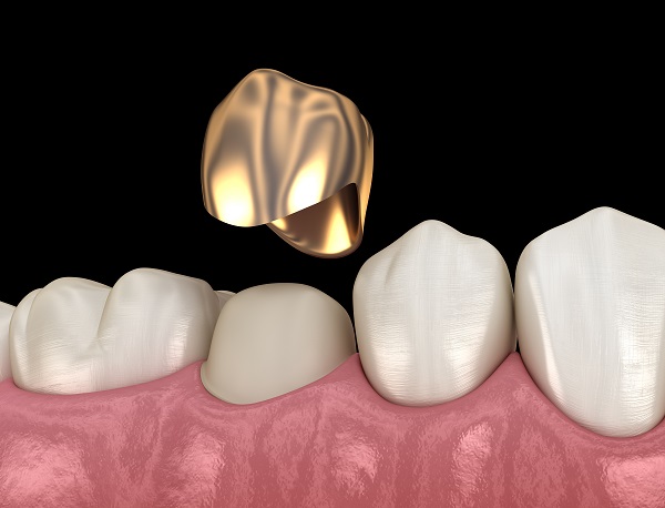 https://dentalimplantmumbai.in/wp-content/uploads/2021/11/Crowns-and-Bridges-1.jpg