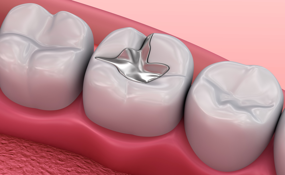 https://dentalimplantmumbai.in/wp-content/uploads/2021/11/Restorative.jpg