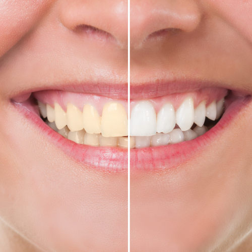 Ten ways teeth whitening boosts your confidence