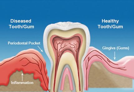 Gum disease & Mobile teeth