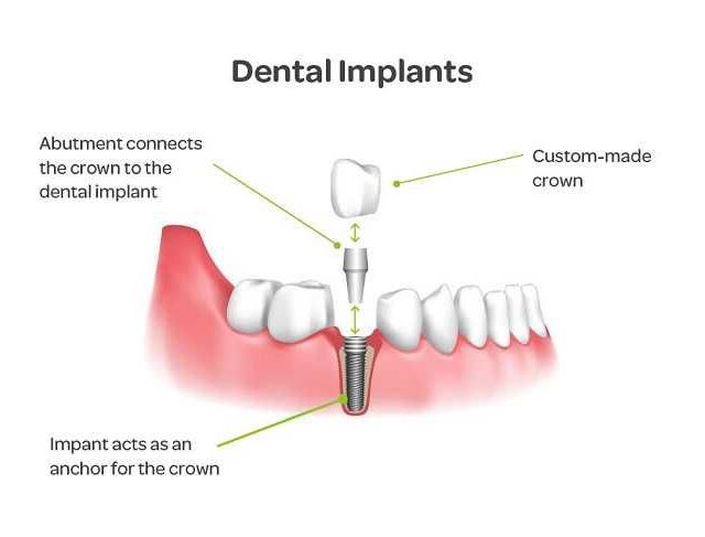 Dental Implants