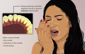 Things you need to know about bad breath and get rid of it.